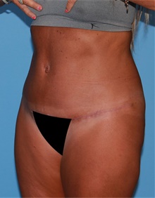 Tummy Tuck After Photo by Siamak Agha, MD PhD FACS; Newport Beach, CA - Case 46782