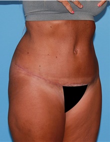 Tummy Tuck After Photo by Siamak Agha, MD PhD FACS; Newport Beach, CA - Case 46782