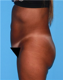 Tummy Tuck Before Photo by Siamak Agha, MD PhD FACS; Newport Beach, CA - Case 46782