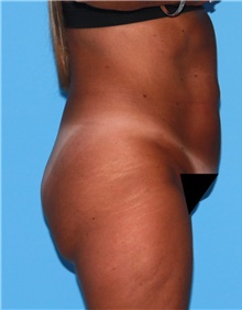 Tummy Tuck Before Photo by Siamak Agha, MD PhD FACS; Newport Beach, CA - Case 46782