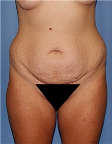 Tummy Tuck Before Photo by Siamak Agha, MD PhD FACS; Newport Beach, CA - Case 46783