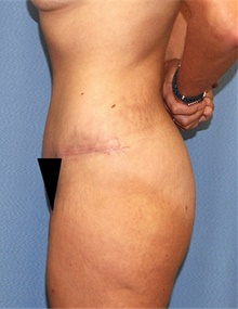 Tummy Tuck After Photo by Siamak Agha, MD PhD FACS; Newport Beach, CA - Case 46783