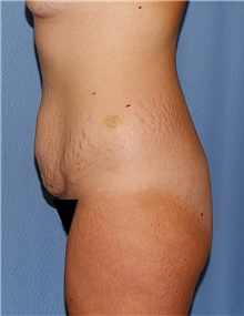 Tummy Tuck Before Photo by Siamak Agha, MD PhD FACS; Newport Beach, CA - Case 46783