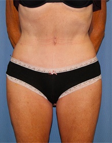 Tummy Tuck After Photo by Siamak Agha, MD PhD FACS; Newport Beach, CA - Case 46784
