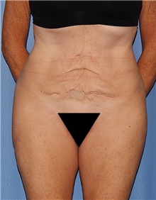 Tummy Tuck Before Photo by Siamak Agha, MD PhD FACS; Newport Beach, CA - Case 46784
