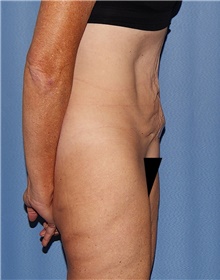Tummy Tuck Before Photo by Siamak Agha, MD PhD FACS; Newport Beach, CA - Case 46784