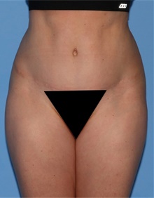 Tummy Tuck After Photo by Siamak Agha, MD PhD FACS; Newport Beach, CA - Case 46785