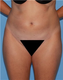 Tummy Tuck Before Photo by Siamak Agha, MD PhD FACS; Newport Beach, CA - Case 46785