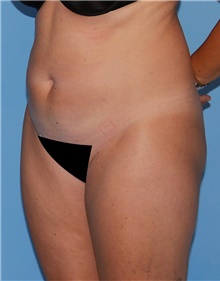 Tummy Tuck Before Photo by Siamak Agha, MD PhD FACS; Newport Beach, CA - Case 46785