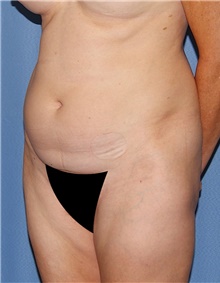 Tummy Tuck Before Photo by Siamak Agha, MD PhD FACS; Newport Beach, CA - Case 46786