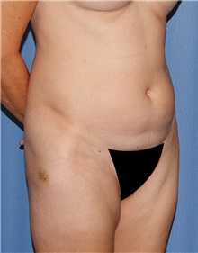 Tummy Tuck Before Photo by Siamak Agha, MD PhD FACS; Newport Beach, CA - Case 46786