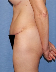 Tummy Tuck After Photo by Siamak Agha, MD PhD FACS; Newport Beach, CA - Case 46786