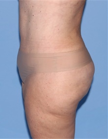 Tummy Tuck After Photo by Siamak Agha, MD PhD FACS; Newport Beach, CA - Case 46787
