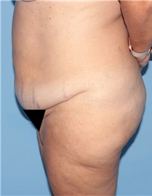 Tummy Tuck Before Photo by Siamak Agha, MD PhD FACS; Newport Beach, CA - Case 46787