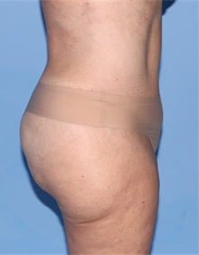 Tummy Tuck After Photo by Siamak Agha, MD PhD FACS; Newport Beach, CA - Case 46787