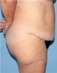 Tummy Tuck Before Photo by Siamak Agha, MD PhD FACS; Newport Beach, CA - Case 46787