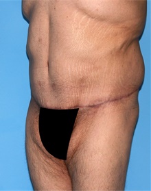 Tummy Tuck After Photo by Siamak Agha, MD PhD FACS; Newport Beach, CA - Case 46788