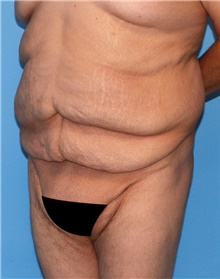 Tummy Tuck Before Photo by Siamak Agha, MD PhD FACS; Newport Beach, CA - Case 46788