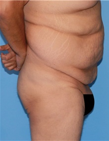 Tummy Tuck Before Photo by Siamak Agha, MD PhD FACS; Newport Beach, CA - Case 46788