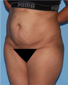 Tummy Tuck Before Photo by Siamak Agha, MD PhD FACS; Newport Beach, CA - Case 46789