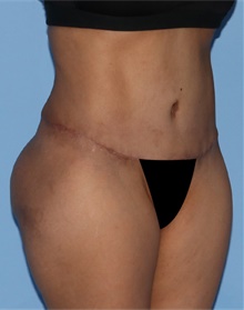 Tummy Tuck After Photo by Siamak Agha, MD PhD FACS; Newport Beach, CA - Case 46789
