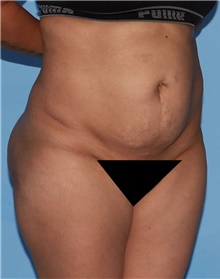 Tummy Tuck Before Photo by Siamak Agha, MD PhD FACS; Newport Beach, CA - Case 46789