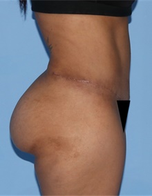Tummy Tuck After Photo by Siamak Agha, MD PhD FACS; Newport Beach, CA - Case 46789