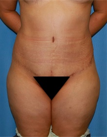 Tummy Tuck After Photo by Siamak Agha, MD PhD FACS; Newport Beach, CA - Case 46790