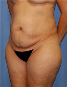 Tummy Tuck Before Photo by Siamak Agha, MD PhD FACS; Newport Beach, CA - Case 46790