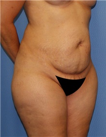 Tummy Tuck Before Photo by Siamak Agha, MD PhD FACS; Newport Beach, CA - Case 46790