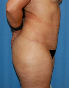 Tummy Tuck After Photo by Siamak Agha, MD PhD FACS; Newport Beach, CA - Case 46790