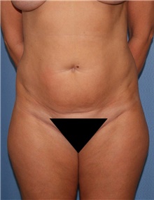 Tummy Tuck Before Photo by Siamak Agha, MD PhD FACS; Newport Beach, CA - Case 46791