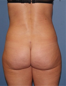 Tummy Tuck After Photo by Siamak Agha, MD PhD FACS; Newport Beach, CA - Case 46791
