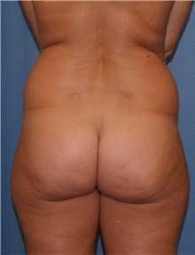 Tummy Tuck Before Photo by Siamak Agha, MD PhD FACS; Newport Beach, CA - Case 46791