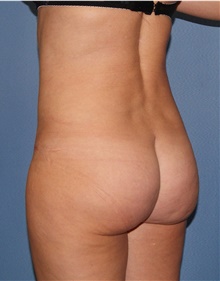 Tummy Tuck After Photo by Siamak Agha, MD PhD FACS; Newport Beach, CA - Case 46791