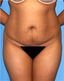 Tummy Tuck Before Photo by Siamak Agha, MD PhD FACS; Newport Beach, CA - Case 46792