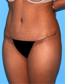 Tummy Tuck After Photo by Siamak Agha, MD PhD FACS; Newport Beach, CA - Case 46792