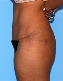 Tummy Tuck After Photo by Siamak Agha, MD PhD FACS; Newport Beach, CA - Case 46792
