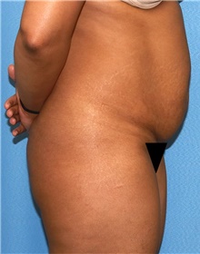 Tummy Tuck Before Photo by Siamak Agha, MD PhD FACS; Newport Beach, CA - Case 46792
