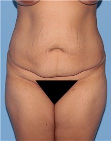 Tummy Tuck Before Photo by Siamak Agha, MD PhD FACS; Newport Beach, CA - Case 46801