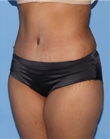 Tummy Tuck After Photo by Siamak Agha, MD PhD FACS; Newport Beach, CA - Case 46801