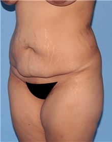 Tummy Tuck Before Photo by Siamak Agha, MD PhD FACS; Newport Beach, CA - Case 46801