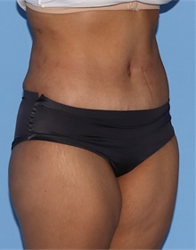 Tummy Tuck After Photo by Siamak Agha, MD PhD FACS; Newport Beach, CA - Case 46801