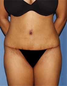 Tummy Tuck After Photo by Siamak Agha, MD PhD FACS; Newport Beach, CA - Case 46802