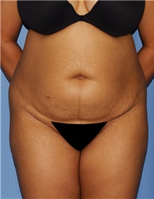 Tummy Tuck Before Photo by Siamak Agha, MD; Newport Beach, CA - Case 46802