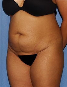Tummy Tuck Before Photo by Siamak Agha, MD PhD FACS; Newport Beach, CA - Case 46802