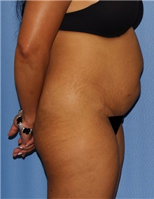 Tummy Tuck Before Photo by Siamak Agha, MD PhD FACS; Newport Beach, CA - Case 46802