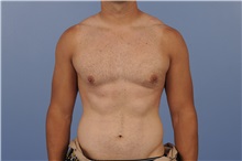 Male Breast Reduction After Photo by Katerina Gallus, MD, FACS; San Diego, CA - Case 33445