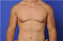 Male Breast Reduction Before Photo by Katerina Gallus, MD, FACS; San Diego, CA - Case 33445