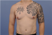 Male Breast Reduction Before Photo by Katerina Gallus, MD, FACS; San Diego, CA - Case 33446